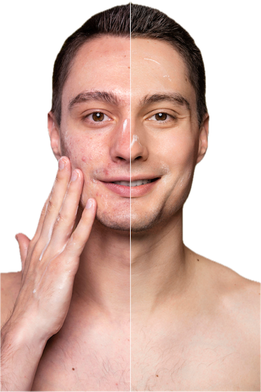 HANDMADE CREAM FOR ACNE-PRONE AND PROBLEMATIC SKIN, 40 ml